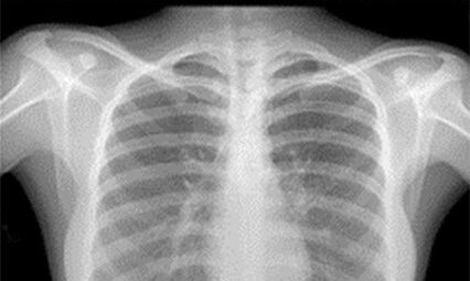 Chest X-ray showing lung fields and heart shadow.
