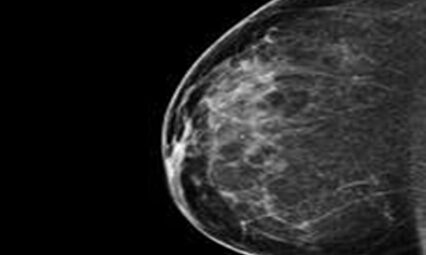 Mammogram X-ray image showing breast tissue.