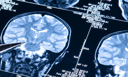 MRI brain scans showing detailed cross-sections of the human brain.