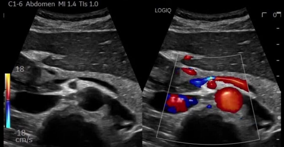 Ultrasound image showing liver with Doppler blood flow analysis.