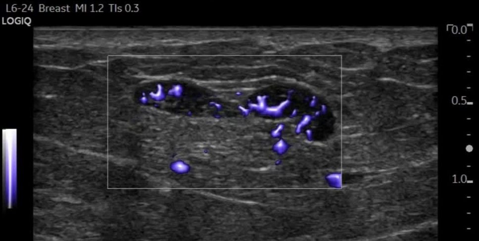 Ultrasound image showing blood flow in a tissue area with blue Doppler signals.