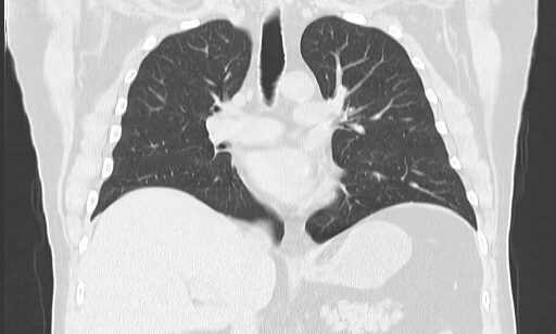 CT scan showing detailed lung and heart structures.