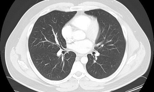 CT scan showing detailed lung and heart structures.