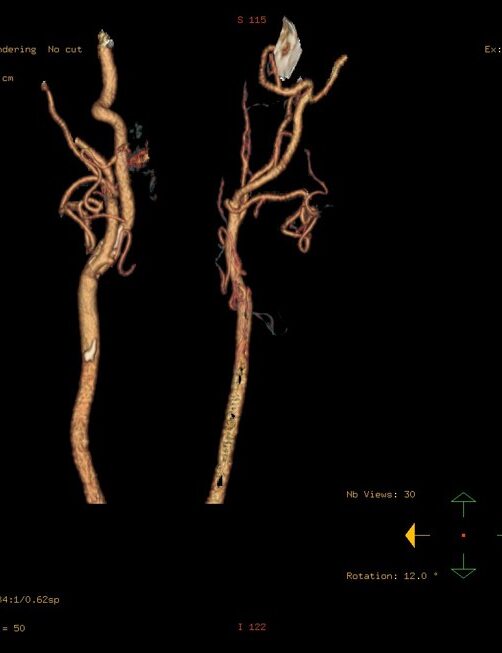 3D angiogram showing carotid arteries with detailed blood flow.