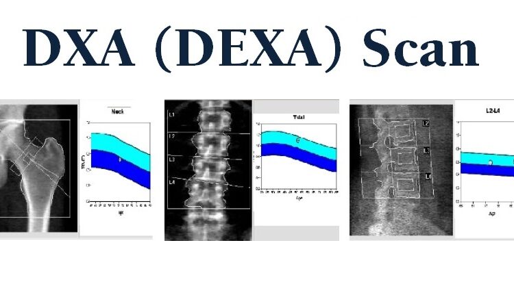 DEXA scan images and corresponding bone density graphs.