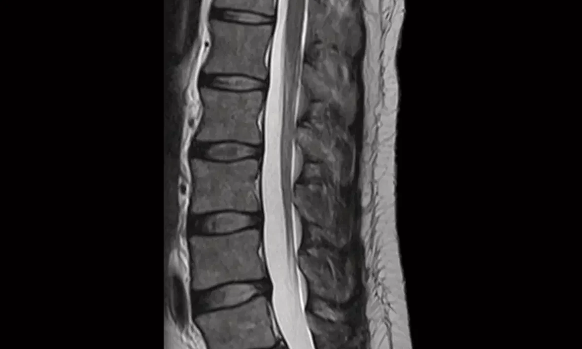 MRI scan of the lumbar spine showing vertebrae and spinal cord.
