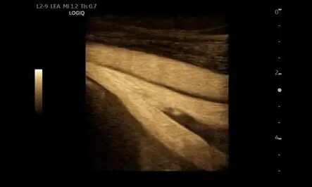 Ultrasound image showing a fetus in early development stage.