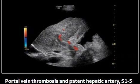 Ultrasound image showing portal vein thrombosis with blood flow in patent hepatic artery.