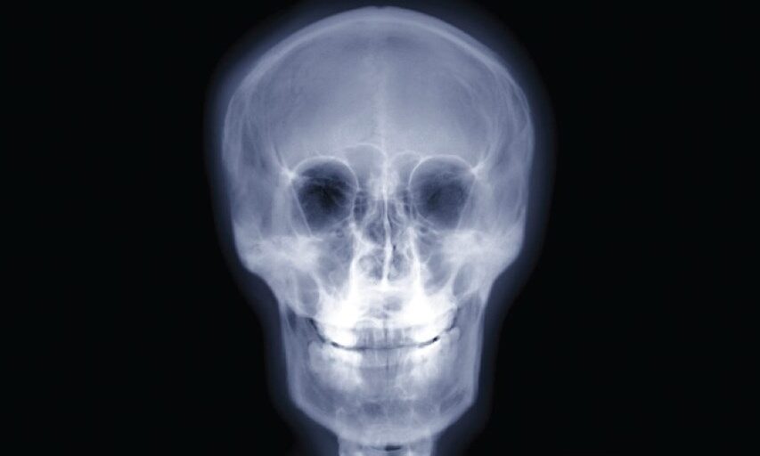 Frontal X-ray image of a human skull showing bone structure.